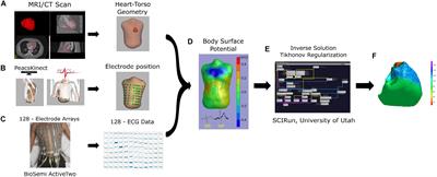 Mechanisms of Arrhythmogenicity in Hypertrophic Cardiomyopathy: Insight From Non-invasive Electrocardiographic Imaging